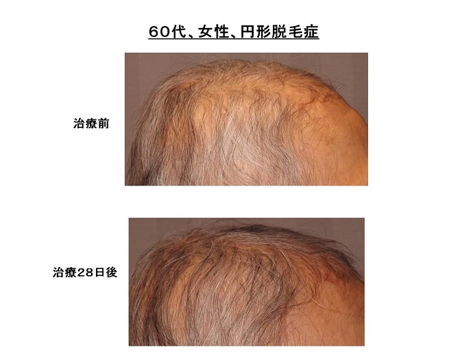 円形脱毛症　病院""